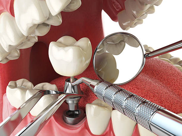 Best Emergency Tooth Extraction in Norridge, IL